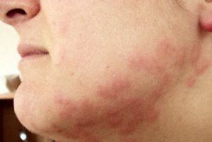 Dust Mite Bites Symptoms
